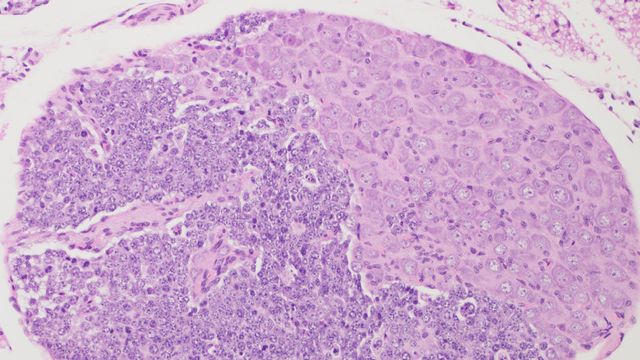 Microscopy image of neuroblast hyperplasia (increased number of precursor nerve cells, shown on the left), within a collection of nerve cell bodies or ganglion from a neuroblastoma-prone mouse.