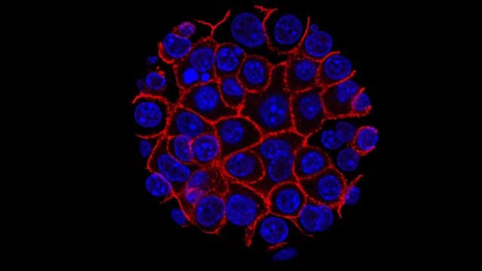 A circle of pancreatic cancer cells, labelled in blue and red.