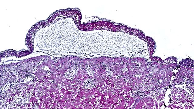 Epidermal detachment by toxic Epidermal Necrolysis.